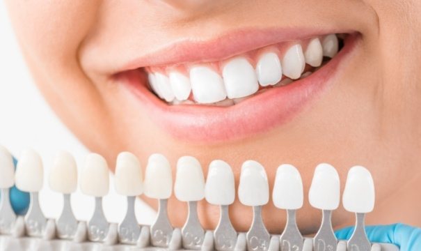 Smile compared with porcelain veneers during cosmetic dentistry visit