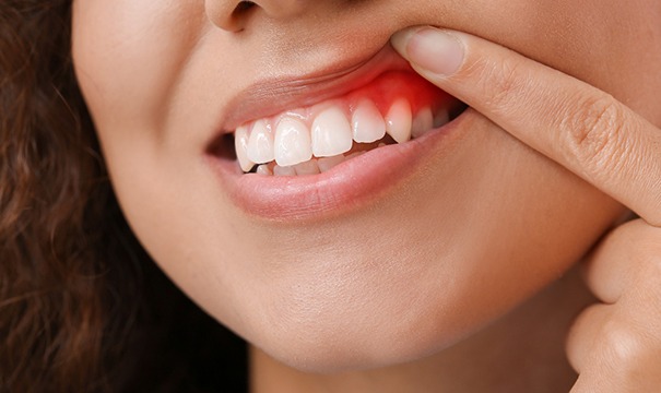 Woman showing signs of gum disease in Boston, MA