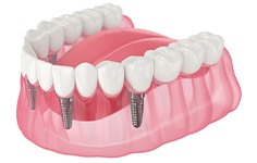 Illustration of an implant denture