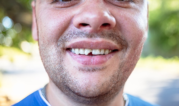 a man smiling with a chipped tooth