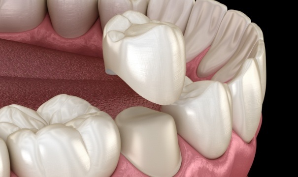 Animated smile during dental crown placement