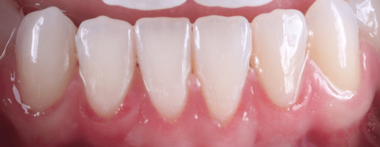 Close up of a mouth with an even gumline after cosmetic periodontal treatment