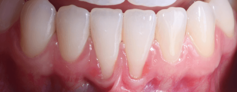 Close up of a mouth with receding gums on the lower arch