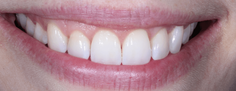 Close up of a smile with an even gumline after gum recontouring