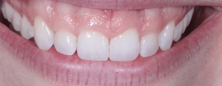 Close up of a gummy smile