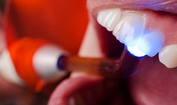 Closeup of smile during dental bonding treatment