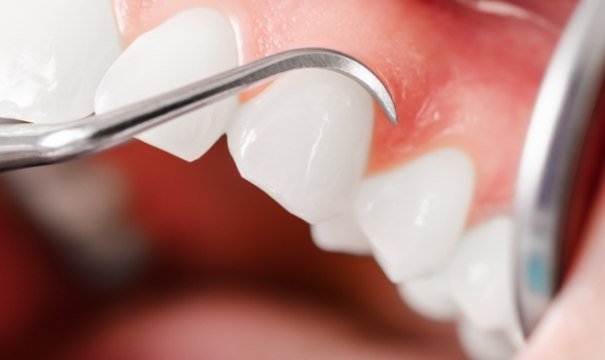 Closeup of smile during gum recontouring