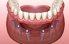 cost of dentures in Boston represented by implants