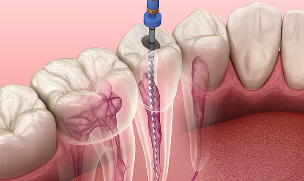 Illustration of root canal therapy for one of the lower teeth