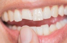 Closeup of smile with chipped front tooth