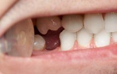 Smile with knocked out tooth