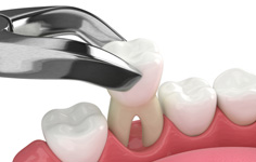 The location of your tooth is an important factor in determining the cost of your tooth extraction
