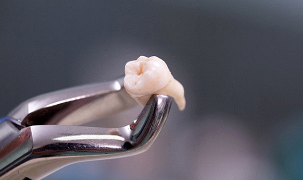 Forceps holding extracted tooth in Boston