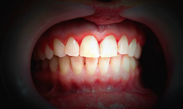 Gums inflamed due to gum disease in Boston, MA