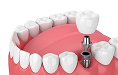 dental implant in Boston
