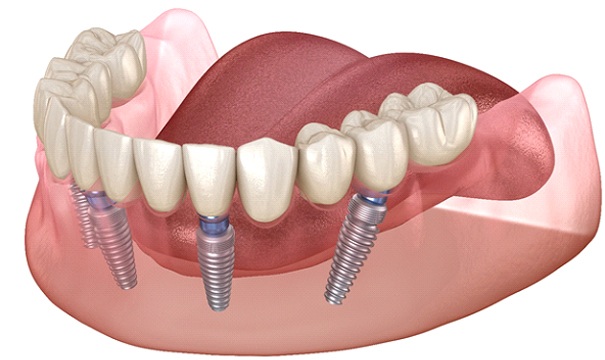 model of how implant dentures in Boston work