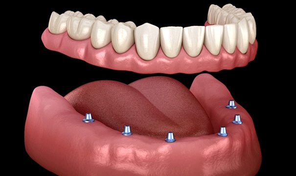 full denture being anchored to six implants