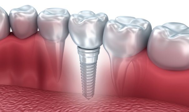 Animated smile with dental implant supported dental crown