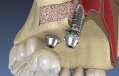Animated smile after bone grafting