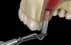 Animated smile during sinus lift surgery