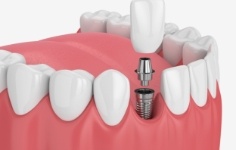 Animated smile during dental implant supported dental crown placement