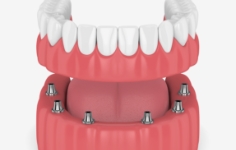 Animated smile during dental implant supported denture placement