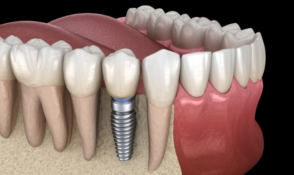 Animated smile with dental implant retained dental crown