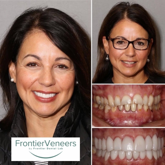 Woman and her smile before and after transforming her smile with cosmetic dentistry