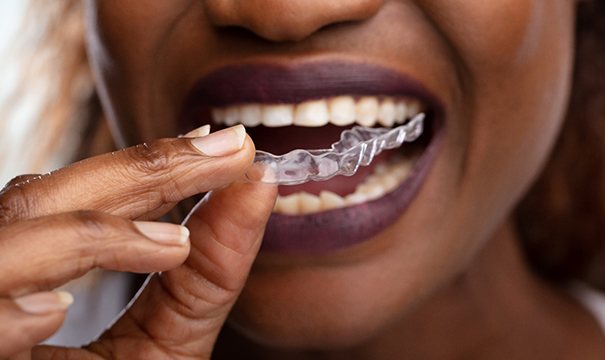 Woman placing Invisalign clear aligner on top teeth