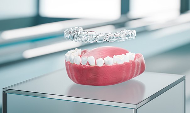 Illustration of clear aligner being placed on misaligned teeth