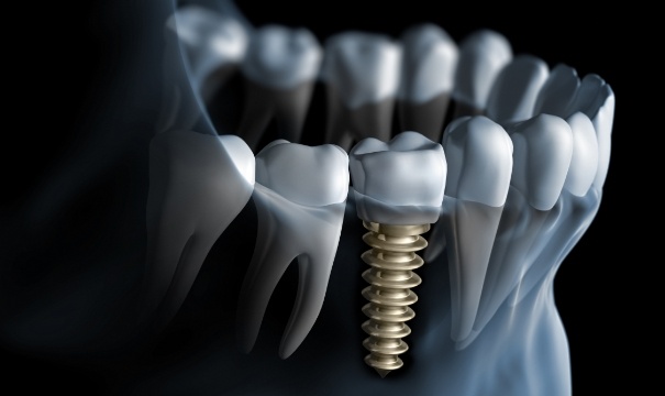 Animated smile with dental implant supported replacement tooth