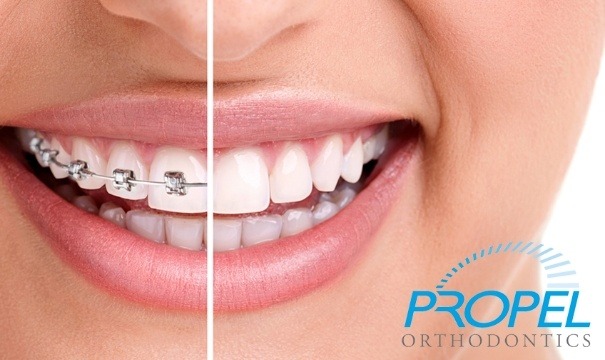 Smile before and after Propel rapid teeth movement treatment