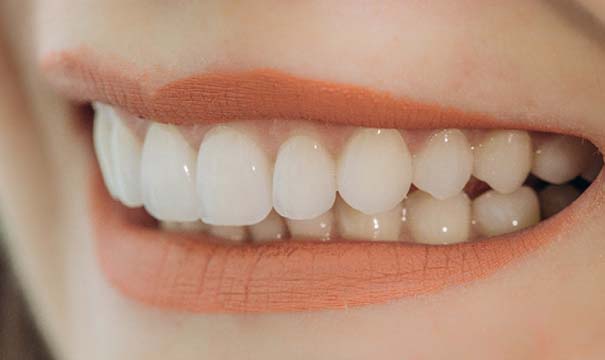 Closeup of woman smiling with veneers in Boston