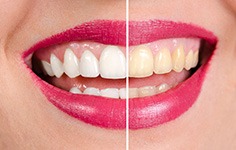 A before and after of a yellow smile