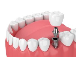 dental implant 3D illustration