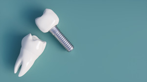 Dental implant laying next to a model tooth