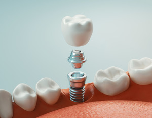 Crown, abutment, and dental implant post in the jaw