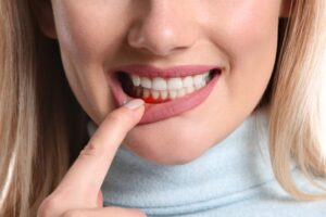 Woman pointing to red, inflamed gums. 