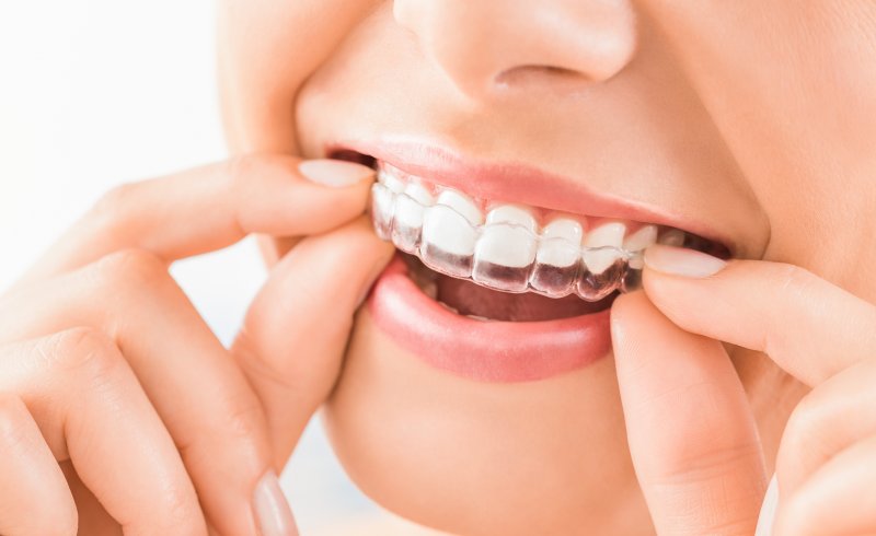 person inserting an Invisalign aligner